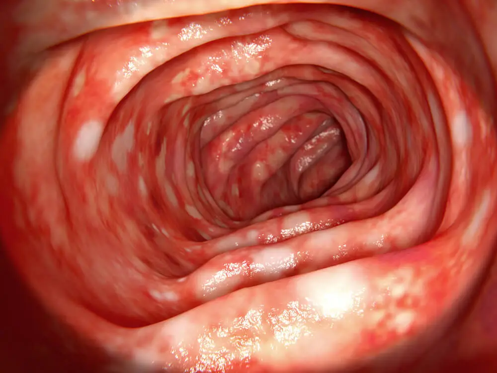 Ulcerative colitis1