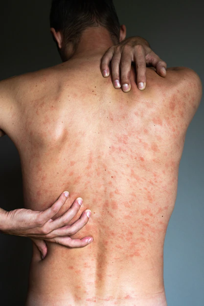 Anaphylaxis