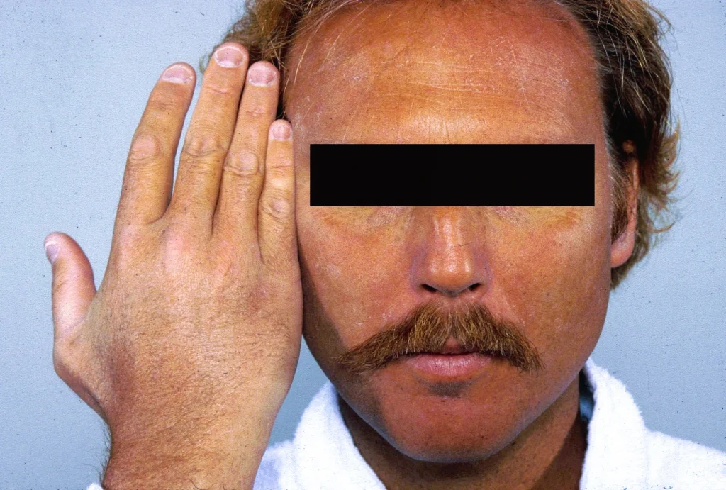 Hemochromatosis 2