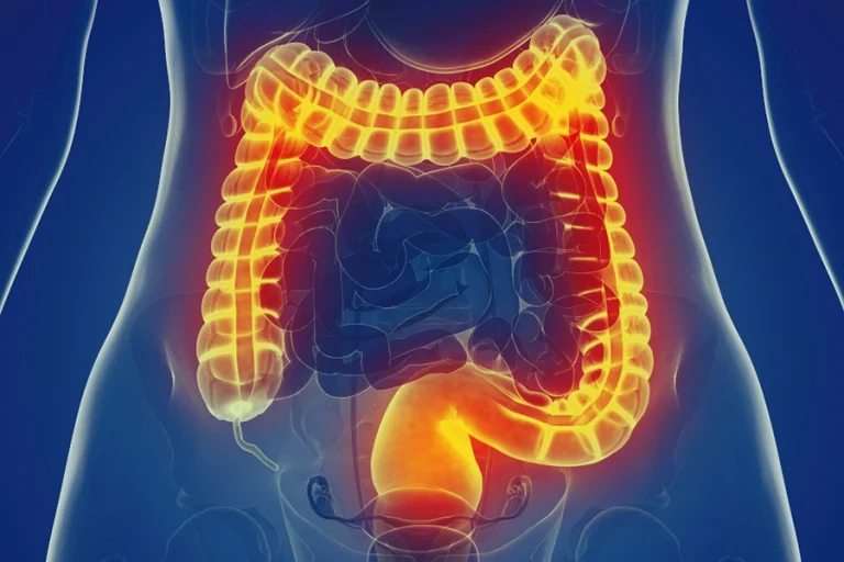 Irritable Bowel Syndrome 1