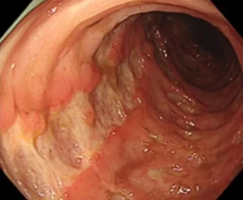 Ulcerative colitis2