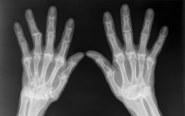 Rheumatoid Arthritis